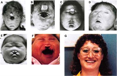 Concepts in Multifactorial Etiology of Developmental Disorders: Gene-Gene and Gene-Environment Interactions in Holoprosencephaly